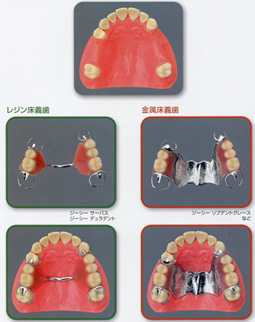 上顎部分床義歯