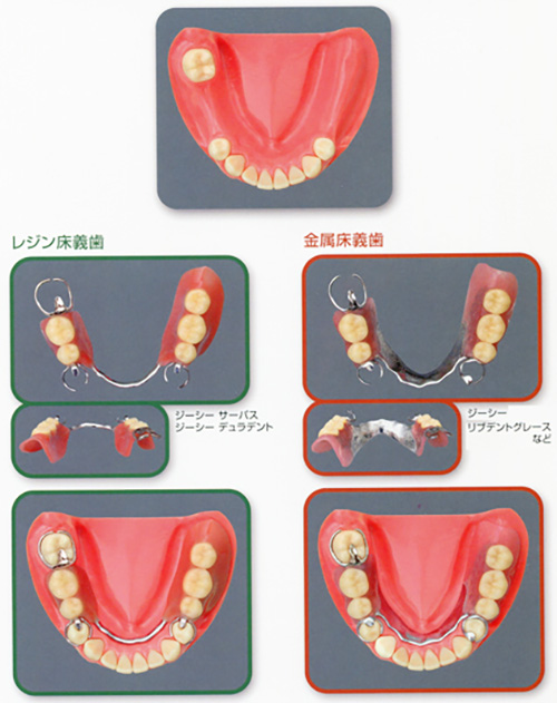 下顎部分床義歯