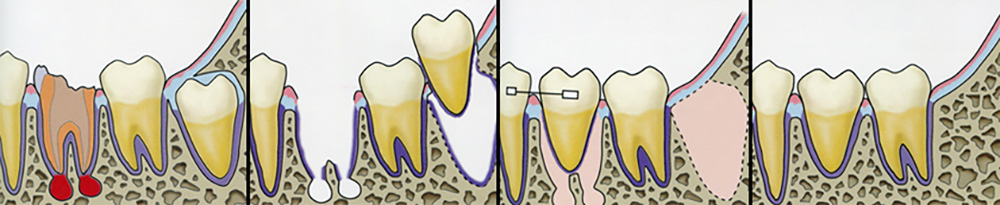 外科と歯の移植