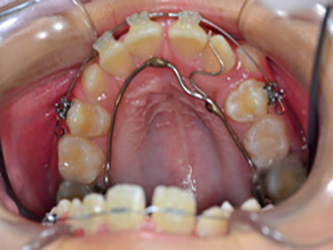 拡大後の前歯のレベリング