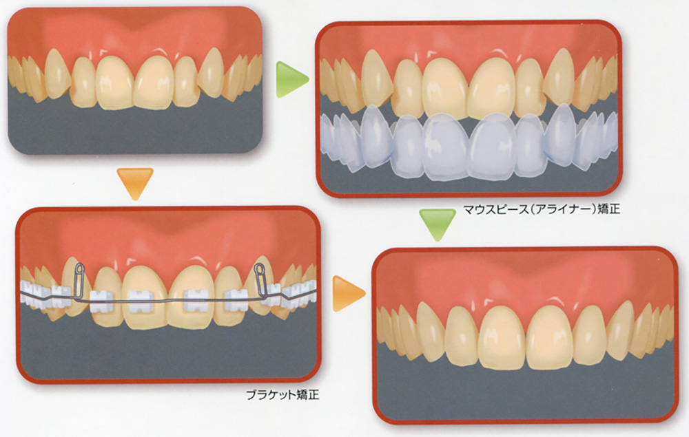 各種歯列矯正（クリアライナー、インビザライン、通常のブラケットとワイヤーによる）