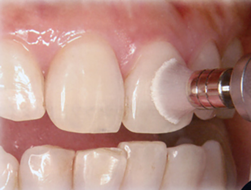歯の表面を徹底的にきれいにする、プロフェッショナル研磨。