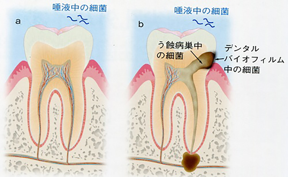 虫歯から細菌感染をおこして膿がたまる。