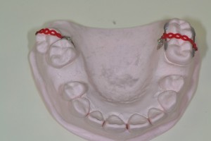 歯牙の圧下と傾斜移動