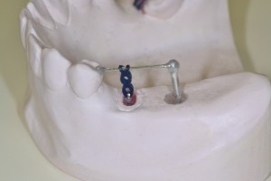 歯牙の挺出
